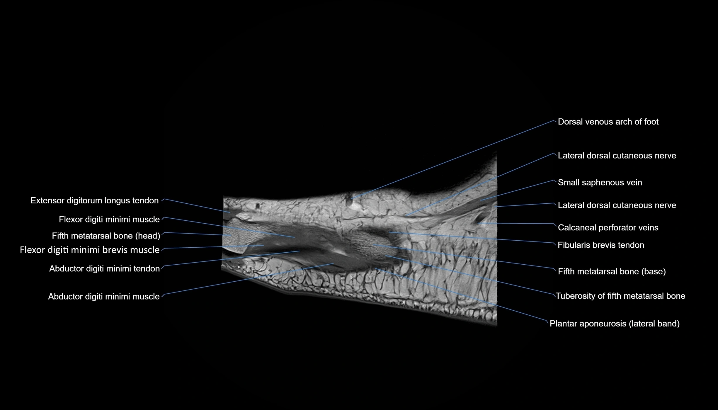 MRI mid foot sagittal cross sectional anatomy 3T  radiology  image-img-00001-00005.webp